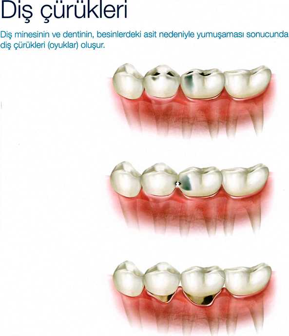 diş çürükleri